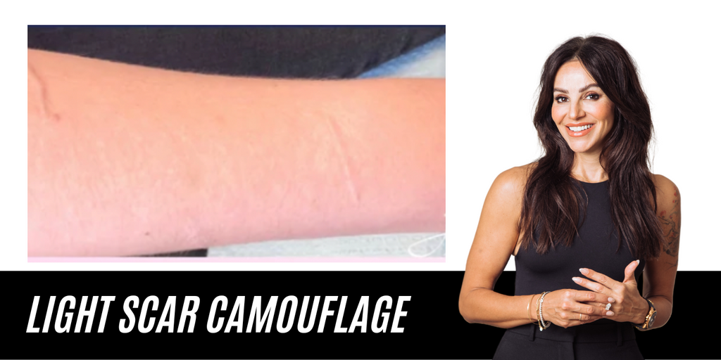 Medical Scar Camouflage Tattoo Treatment in CT [Call NOW]