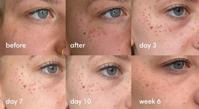FAUX FRECKLES