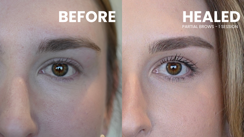 The Partial Brow Method