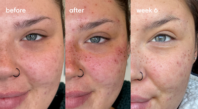 FAUX FRECKLES