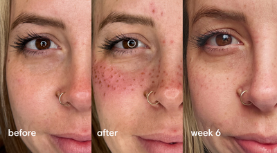 FAUX FRECKLES