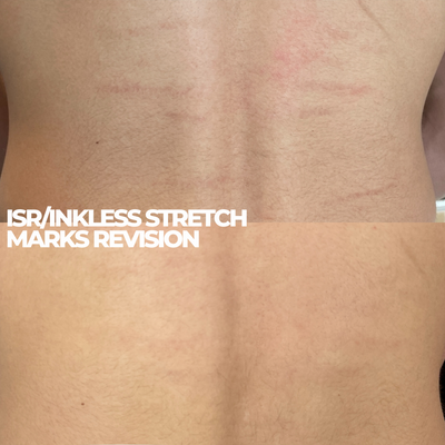 INKLESS STRETCH MARKS REVISION
