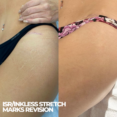 INKLESS STRETCH MARKS REVISION