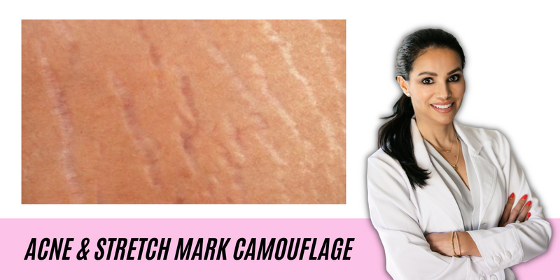 ACNE & STRETCH MARK CAMOUFLAGE | PARAMEDICAL TATTOO COURSE